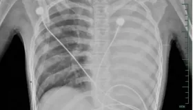 12 岁女孩感冒 1 天变 “白肺”！这种 “黏液堵气道” 的急症家长必看