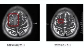 白酒泡、醋腌能杀寄生虫？大错特错！疾控专家：只有100℃高温才能救命