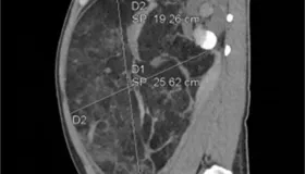医讯网：33岁男子腹痛就医，竟查出篮球大肾错构瘤破裂大出血！