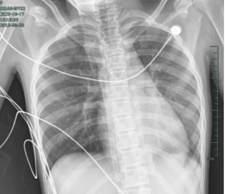 12 岁女孩感冒 1 天变“白肺”！这种“黏液堵气道”的急症家长必看