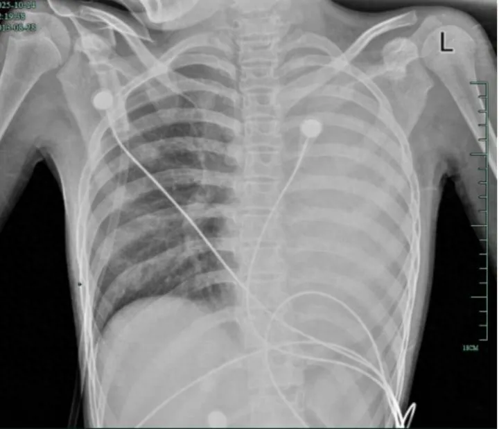 12 岁女孩感冒 1 天变“白肺”！这种“黏液堵气道”的急症家长必看