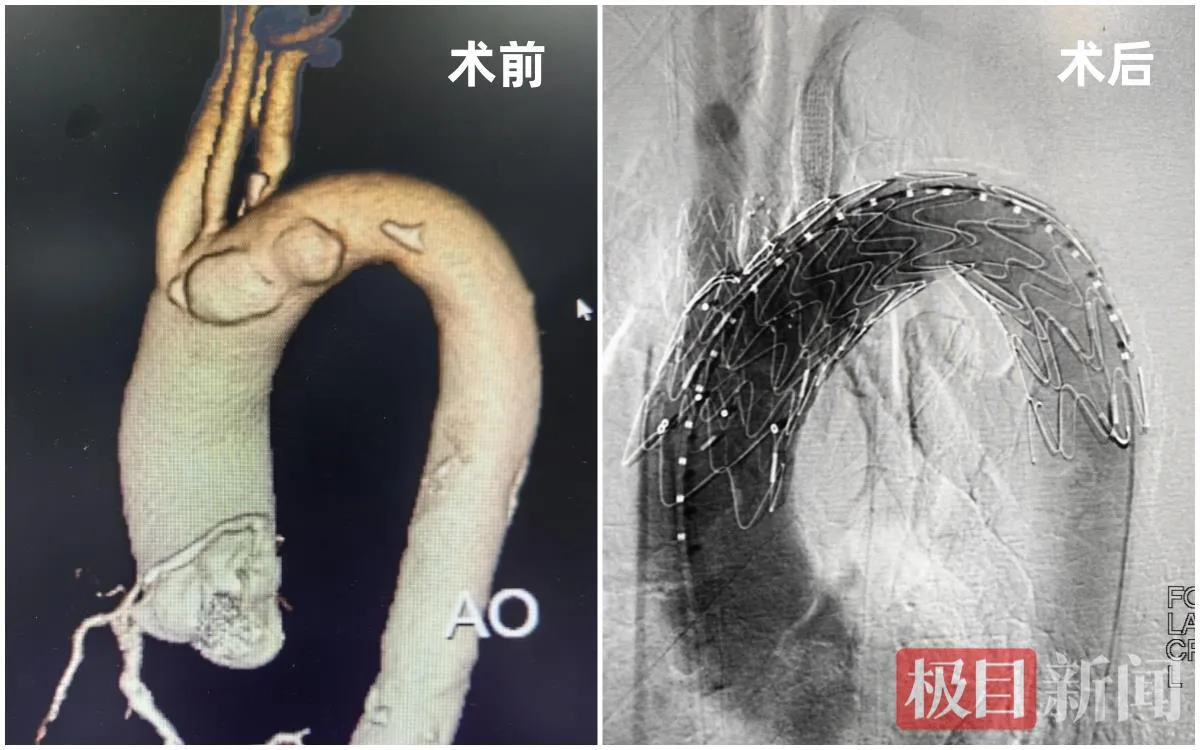 武汉大学人民医院如何救治高龄危重主动脉疾病患者?“3S”理念与 3D 打印技术有何妙处? 武汉大学人民医院如何救治高龄危重主动脉疾病患者?“3S”理念与 3D 打印技术有何妙处?