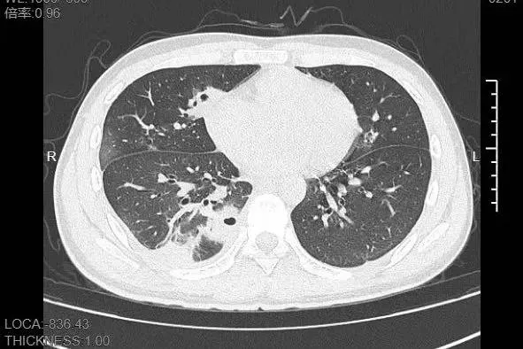 20 岁男生挤痘进 ICU，脸部“危险三角区”痘痘为啥不能挤？有何风险？