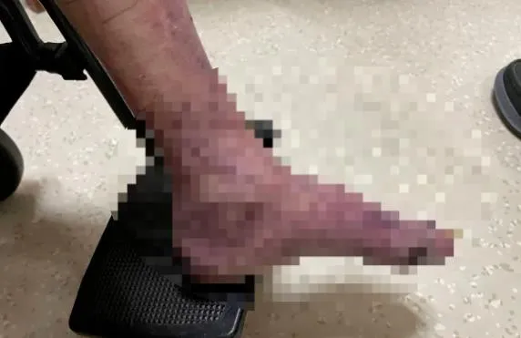 一爷叔疼痛难忍，差点截肢！医生：正值高发期！不是关节的锅...