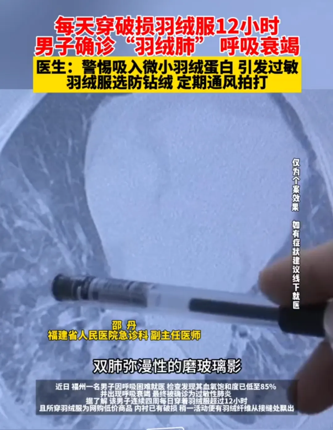 男子确诊“羽绒肺”呼吸衰竭！医生提醒→