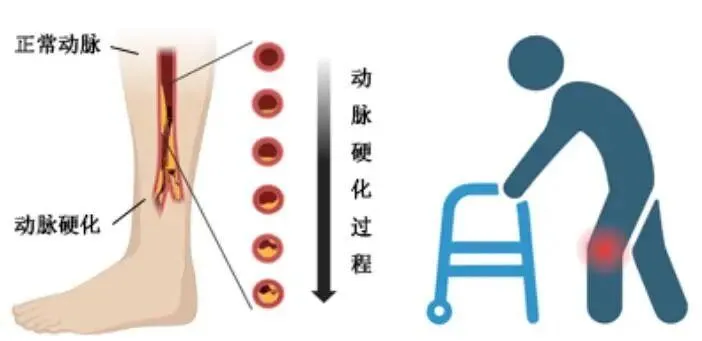 一爷叔疼痛难忍，差点截肢！医生：正值高发期！不是关节的锅...