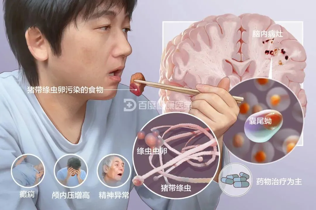 白酒泡、醋腌能杀寄生虫？大错特错！疾控专家：只有 100℃高温才能救命