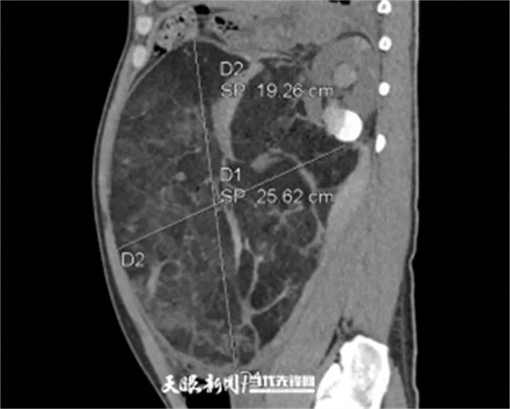 医讯网：33 岁男子腹痛就医，竟查出篮球大肾错构瘤破裂大出血！