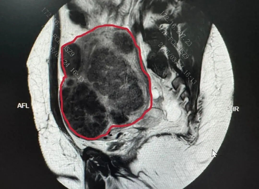 痛经 23 年、血崩至重度贫血，被建议切除子宫！她跨国求医，医生剔除 656 个肌瘤保住子宫