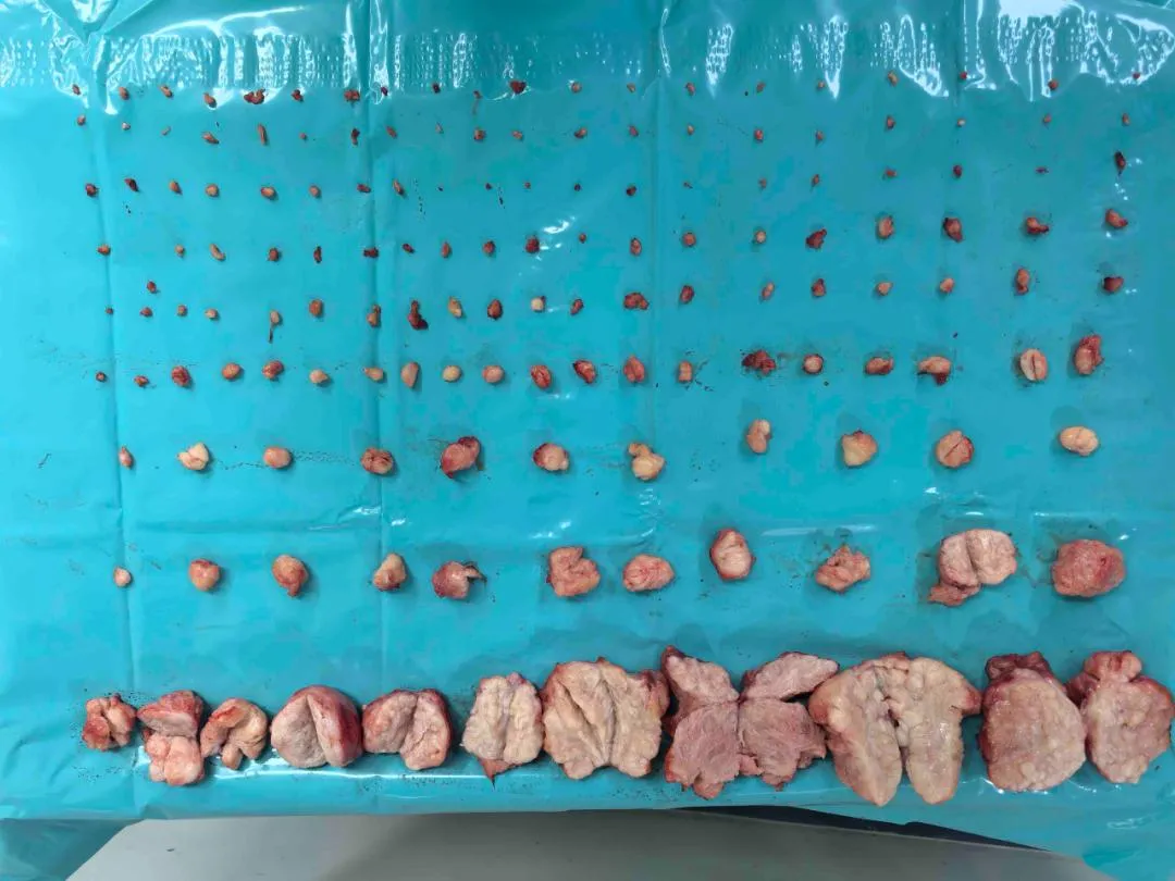 痛经 23 年、血崩至重度贫血，被建议切除子宫！她跨国求医，医生剔除 656 个肌瘤保住子宫